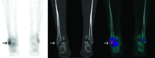 bone scan